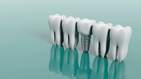 Dental Implants Leichhardt Dental Implants Leichhardt
